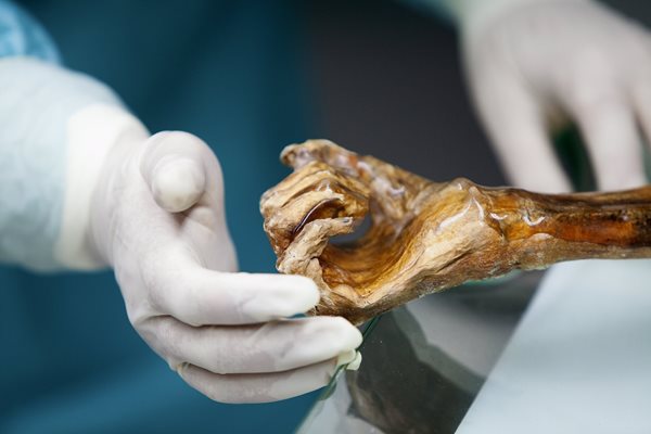 Учен от Европейската академия в Болцано, Северна Италия, изследва мумифициран труп на 5300 години, известен като Ледения човек, или Йоци, който дава сведения за непозната стомашна инфекция.