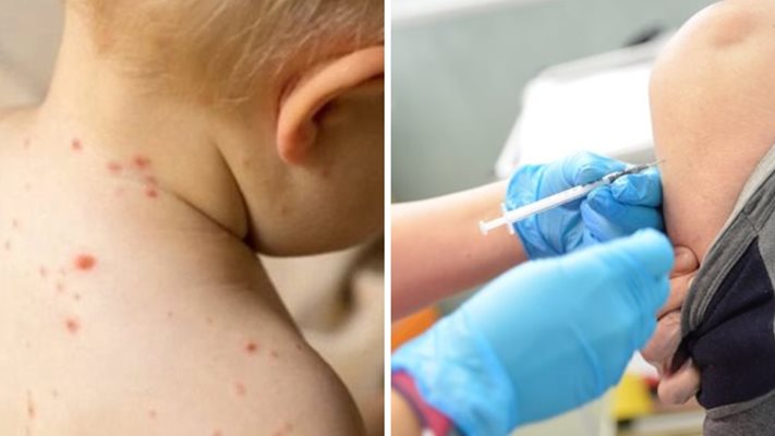Първи случай на морбили у нас: зарази се ваксинирано дете