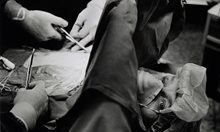 Операции без анестезия в древността