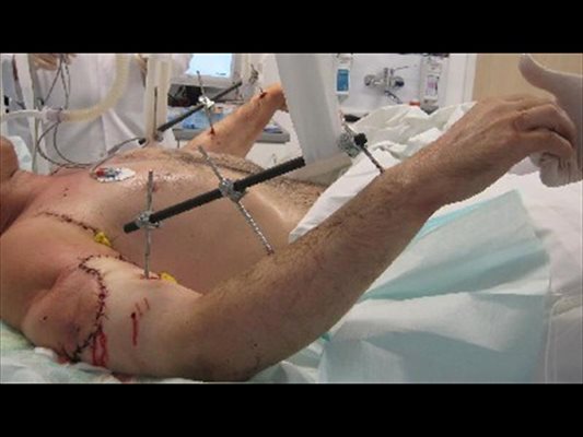 Така изглежда мъжът с трансплантираните ръце дни след операцията през лятото. Оттогава той раздвижва присадените крайници със специални упражнения. След година се очаква да развие чувствителност на китките. 
