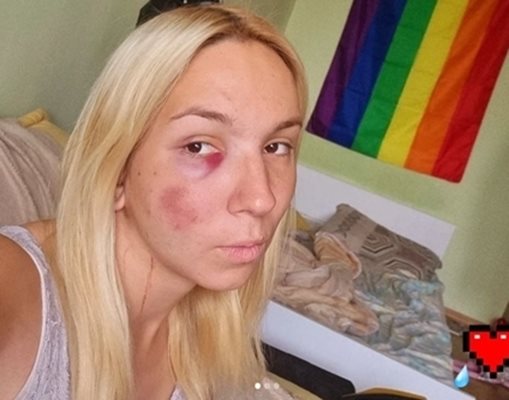 Емили е с наранявания по лицето и тялото СНИМКА: Инстаграм/Официален профил