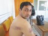 Мъж с отстранен тестис след зверски побой от охранители