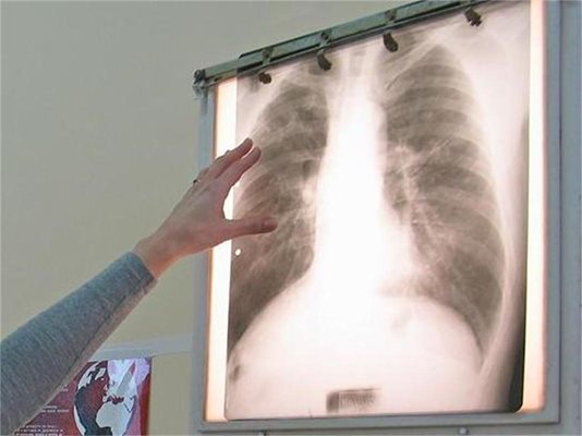 Безплатни прегледи за туберкулоза ще се извършат в Пловдив.
СНИМКА: Архив