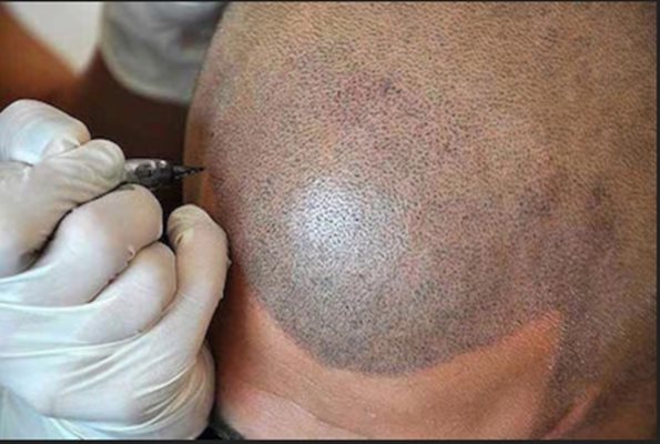 Татуирането на коса може да спести много психични проблеми на мъже, които свързват оплешивяването със загуба на своята мъжественост.