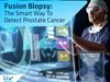 Фюжън биопсия: По-голяма прецизност и по-добри резултати при диагностиката на рак на простатата