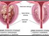 Страдате ли от  увеличена простата?