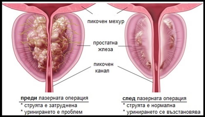 Страдате ли от  увеличена простата?