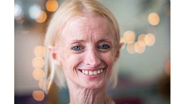 Tiffany, who ages 8 times faster: The disease took away my teeth, but not the smile