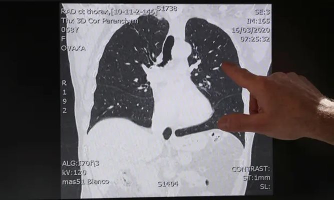 Лекар в Белгия показва снимка от скенер на белите дробове на човек, страдащ от коронавирус СНИМКА: Ройтерс 