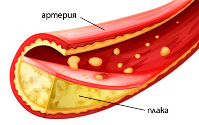 Холестеролът се натрупва в кръвоносните съдове под формата на плаки