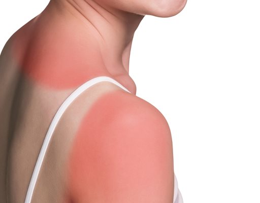 Слънцето е особено опасно за кожата - изсушава я, прави я чувствителна и повишава риска от появата на петна и бенки по тялото.