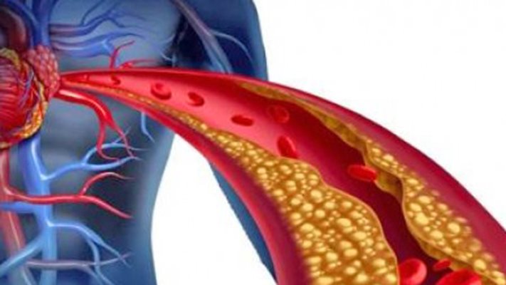 Атеросклерозата има илачи от народната медицина