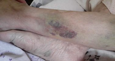 104-годишна жена е със синини и травми след лечение в болницата във Видин (снимки)