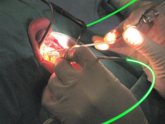 Хирурзи от ИСУЛ за първи път  костен имплант на мъж с  вродена загуба на слуха, който ще започне да чува след тази уникална операция.
