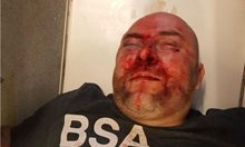 BG гражданин пребит от расисти в Шотландия. 39-годишният Илхан Ахмедов бил със счупен нос и лицева кост