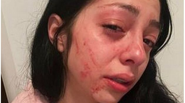 Бившата приятелка на Васил - Боряна, показа нараненото си лице в социалната мрежа.

СНИМКА: ФЕЙСБУК