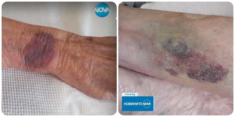 УЖАС! Връзвали в болница 104-годишна жена, изписана със синини