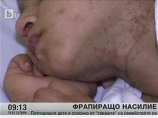 След родителски &quot;грижи&quot;: 5-годишно момче е цялото в рани, загуби 4 пръстчета на краката