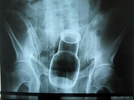 Рентгеновата находка - бутилката в ануса на хасковлията.
СНИМКА: МНОГОПРОФИЛНА БОЛНИЦА - ХАСКОВО