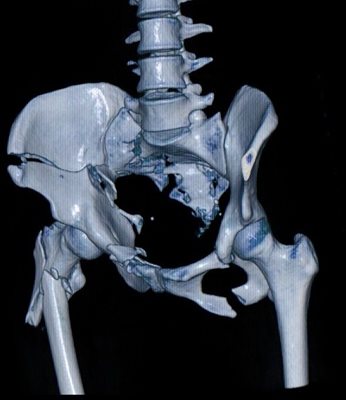 Диагностичното 3-измерно изображение на счупванията на таза на един от последните пациенти на проф. Енчев и по-долу - рентгеновите снимки след операцията - множеството счупвания са фиксирани по световен стандарт и до 12 седмици се очаква човекът да ходи без помощни средства.