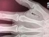 Американец си имплантира безжични чипове в ръцете (видео)