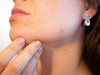 Учени в САЩ разработват ваксина срещу акне