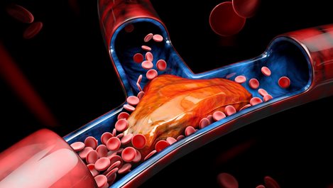 Запушените артерии могат да доведат до инсулт и инфаркт, как да ги изчистим
