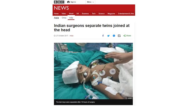 Хирурзи разделиха сиамски близнаци в Индия