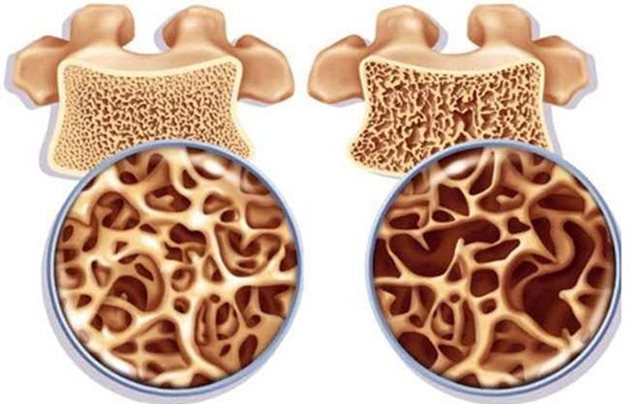 Здрава костна тъкан (в ляво) и засегната от остеопороза (в дясно)