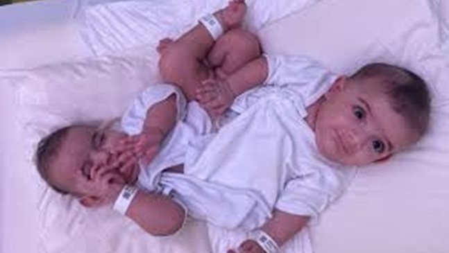 Лекари от Саудитска Арабия успешно разделиха сиамски близнаци