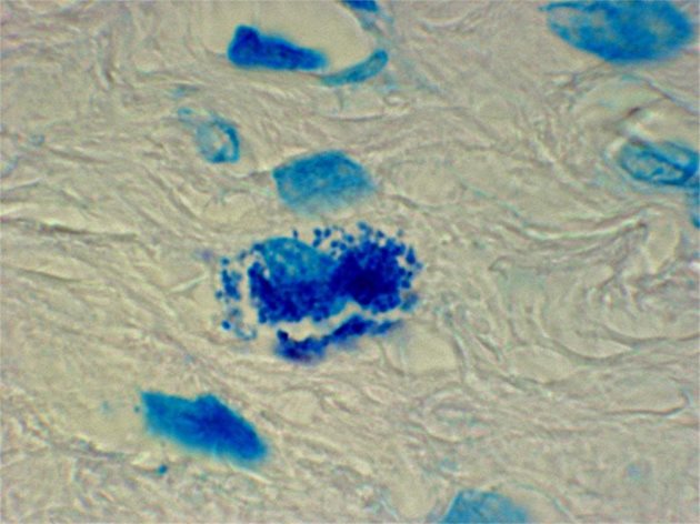 ПОД МИКРОСКОП: Вътреклетъчни кокоидни форми при рак на простатата. Снимка: Архив