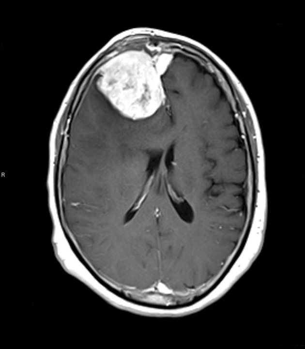 Гигантският менингиом, който освен че се вижда ясно на ядрено-магнитния резонанс, е бил буквално „изписан“ на челото на пациентката. Публикуваме изображението със съдействието на пиара на болницата.