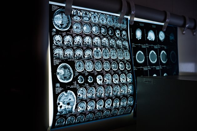 Компютърното виждане при анализа на медицинските изображения отваря нови перспективи за откриване на най-ранните тревожни сигнали за дадено страдание.