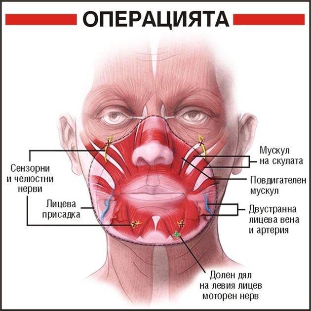 Графика на извършената трансплантация на Изабел Диноар.