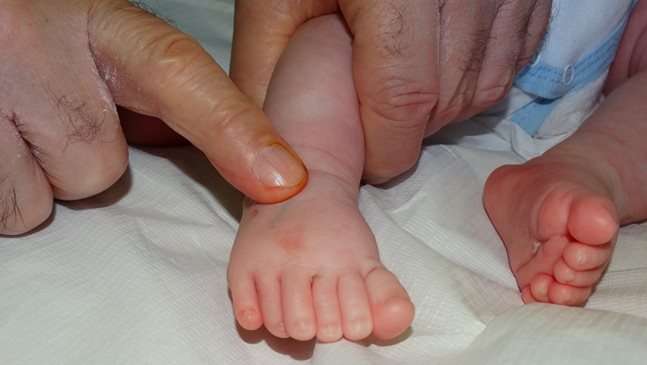 Оперираха бебе с шест пръста на ръцете и краката в болница в Бургас