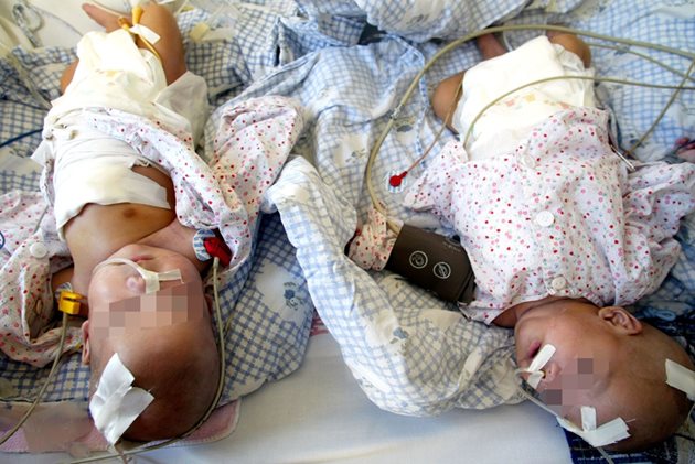След разделянето повечето близнаци се нуждаят от интензивна рехабилитация.