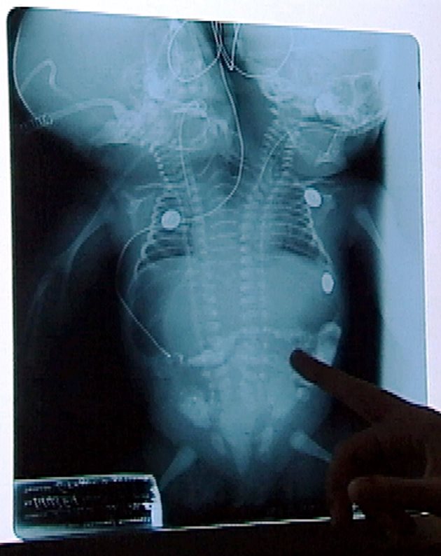 Рентгенова снимка на сиамски близначки, родени от 15-годишна гватемалка през 2012 г. Лекарите са категорични още при първите прегледи, че безопасното им разделяне е невъзможно, тъй като имат само едно сърце.
